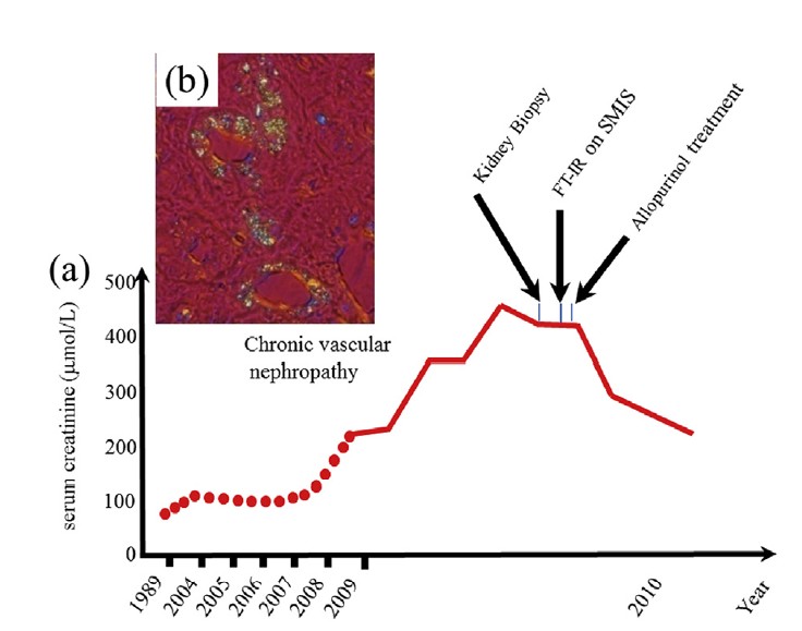  Evolution de la fonction rénale donnée par le sérum de créatinine